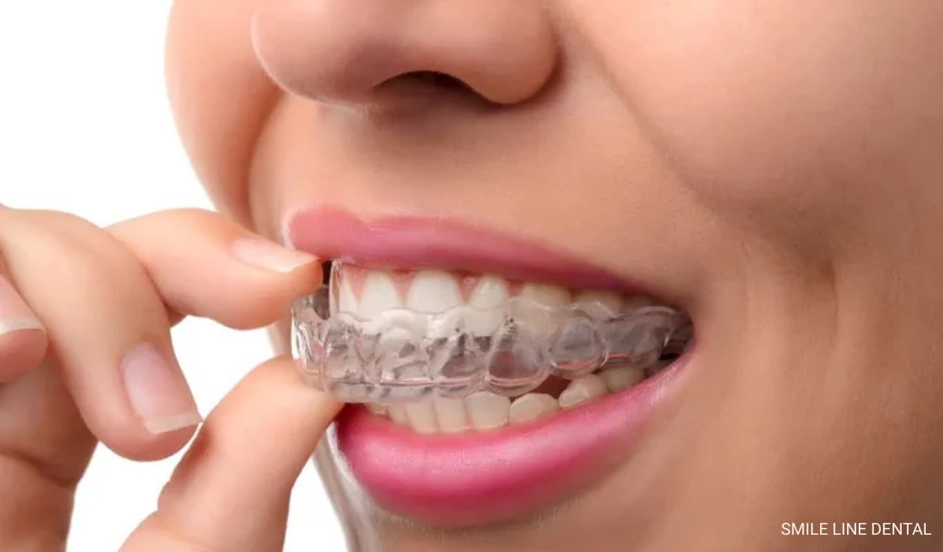 Invisalign
