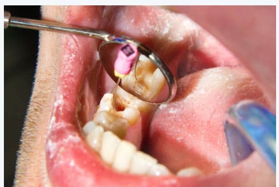 Root Canal Treatment