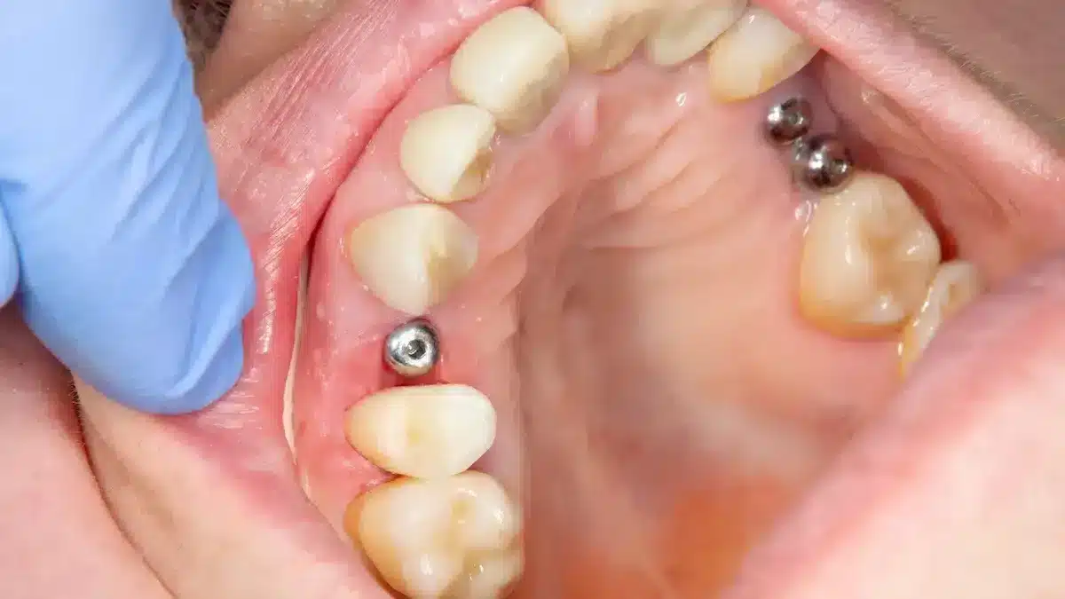 Dental Implant