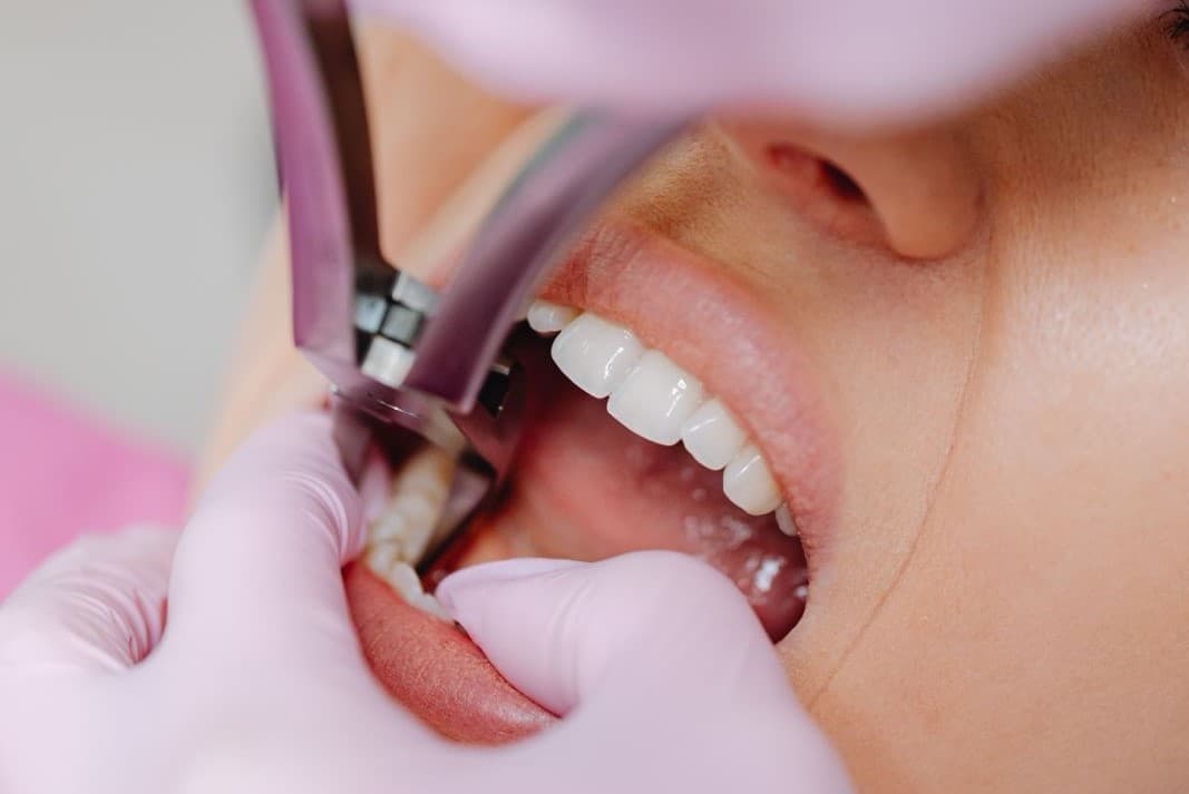 Tooth Extraction